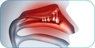 nasal-polyps